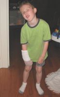 Keefer's temporary cast - Click for enlargement!